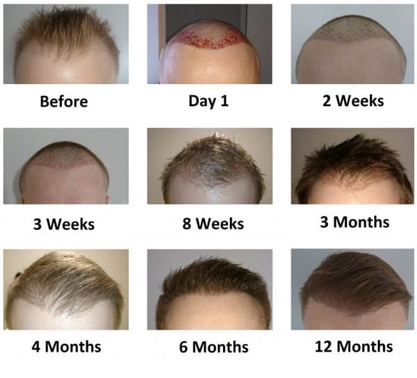 مراحل نمو الشعر بعد الزراعة