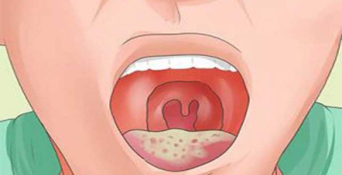 متى تظهر أعراض الإيدز في الفم وطرق العلاج