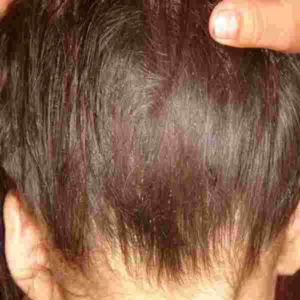 علاج التهاب فروة الرأس وتساقط الشعر زيادة