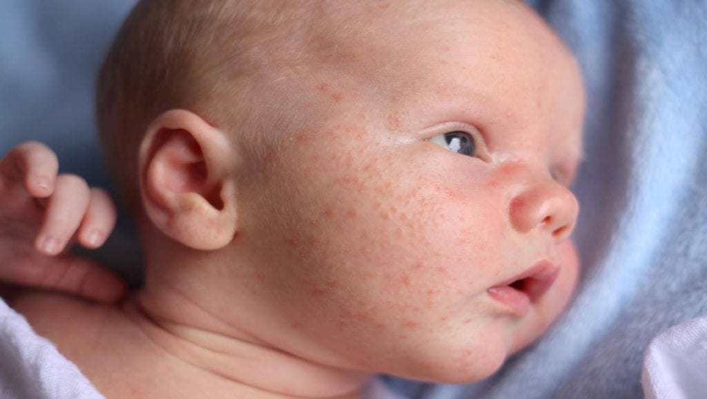 طرق علاج حساسية الجلد عند الأطفال الرضع موقع زيادة