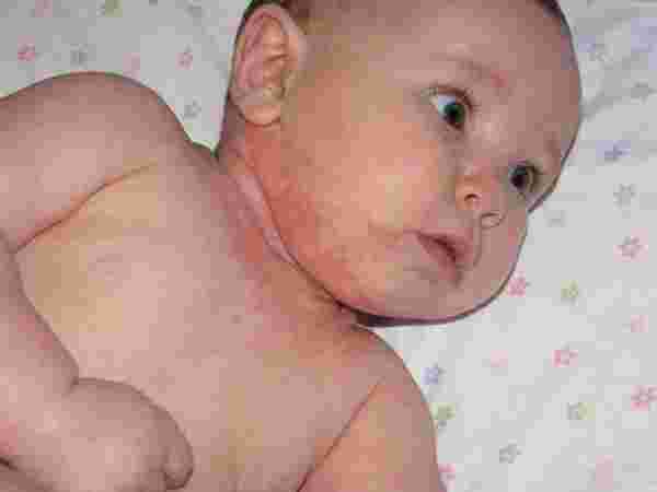 مؤشرات خطيرة لحساسية الجلد عند الأطفال