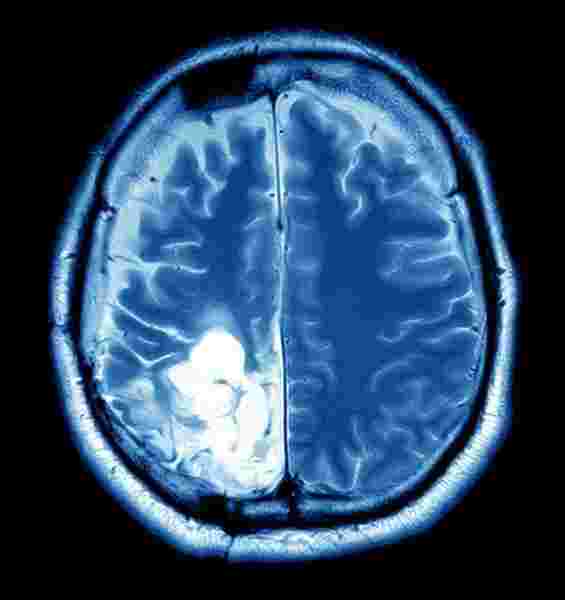 ما هي خيارات العلاج المتاحة لعلاج ورم الدماغ ؟