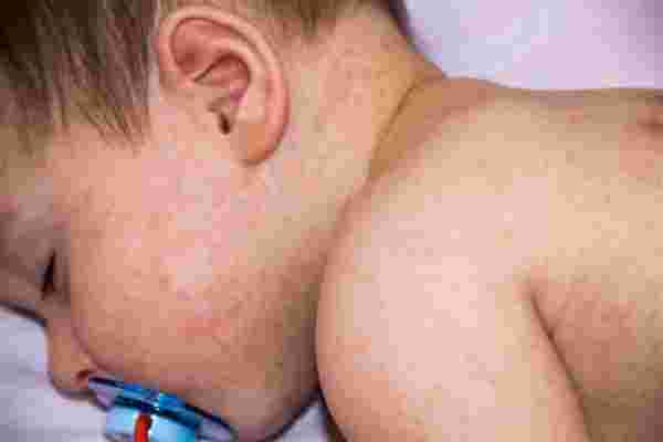 أعراض حساسية الجلد عند الأطفال من الأكل