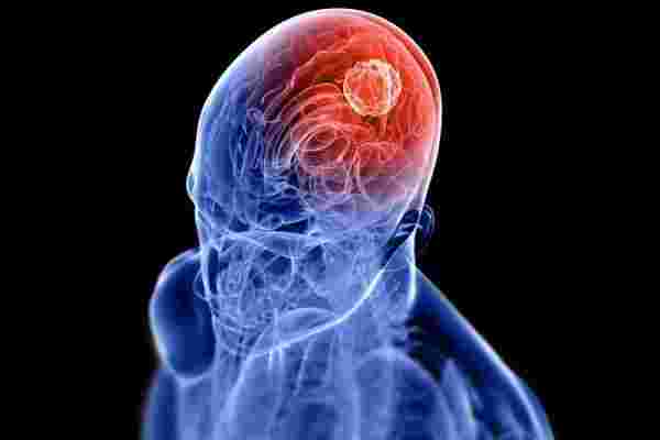 أعراض مرض السرطان في الرأس