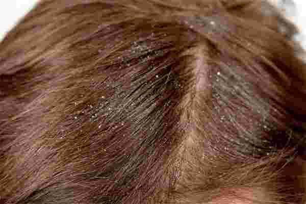 علاج التهاب فروة الرأس وتساقط الشعر