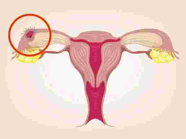 متى تبدا اعراض الحمل خارج الرحم بالظهور ؟
