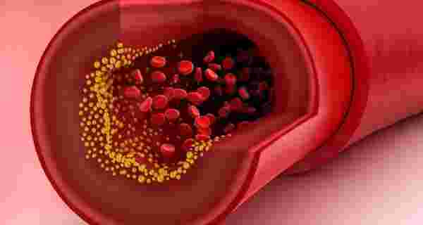 مضاعفات ارتفاع الكوليسترول في الدم