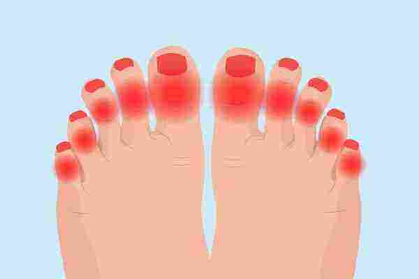 علاج التهاب اصبع القدم الكبير بالأعشاب زيادة