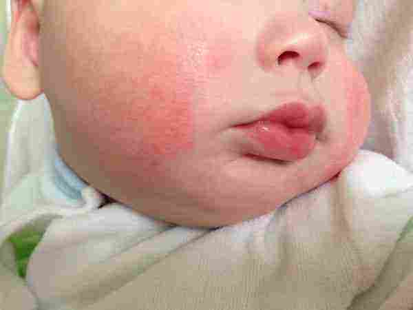 ظهور بقع حمراء على الجلد عند الأطفال وكيفية التعامل مع وتشخيصه وعلاجه زيادة