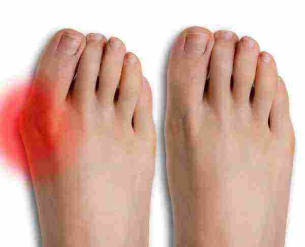 علاج التهاب اصبع القدم الكبير بالأعشاب زيادة