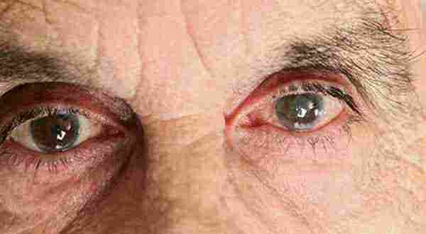 أعراض الإصابة بالمياه البيضاء على العين