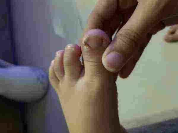 أعراض التهاب اصبع القدم الكبير ( أعراض الإصبع المدحوس )