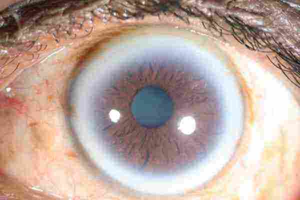 علاج احمرار العين بعد عملية المياه البيضاء
