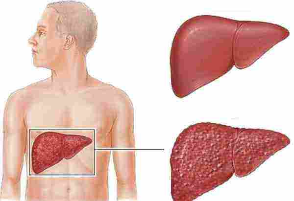 مضاعفات التهاب الكبد