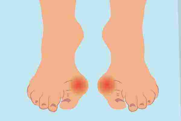 منع التهاب إصبع القدم الكبير ( الوقاية من التهاب اصبع القدم الكبير )