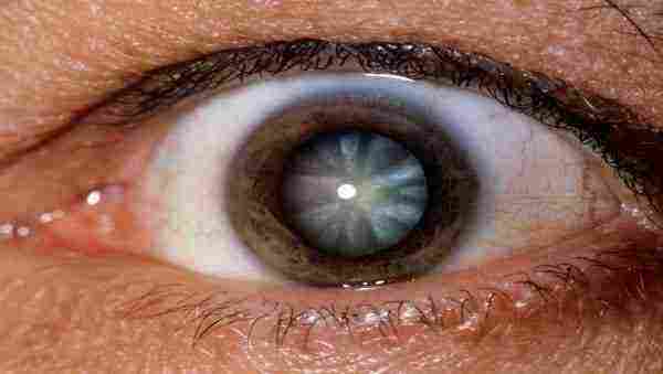 نصائح تساعد في علاج المياه البيضاء على العين