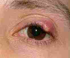 علاج الكيس الدهني بالعين