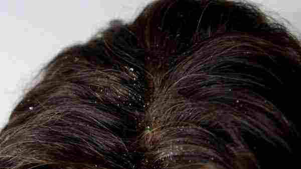 علاج فطريات الشعر بالطب البديل