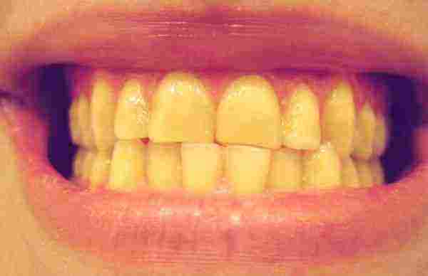 كيفية التخلص من الأسنان الصفراء