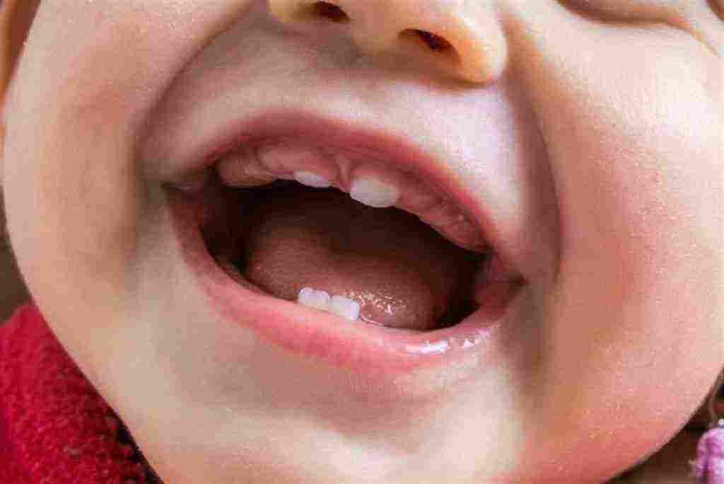 علاج التهاب اللوزتين عند الاطفال – زيادة