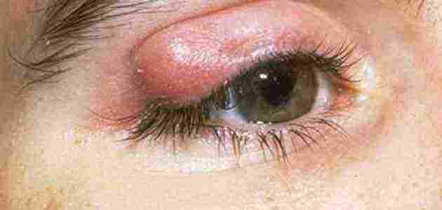 أسباب ظهور حبوب داخل جفن العين - زيادة