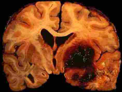 هل يشفى مريض نزيف المخ وأبرز الأسباب والأعراض زيادة