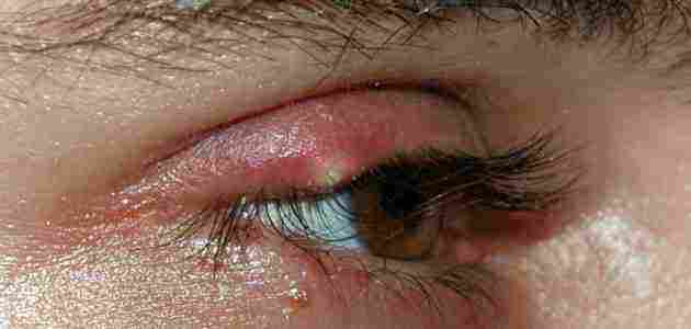 أسباب ظهور حبوب داخل جفن العين