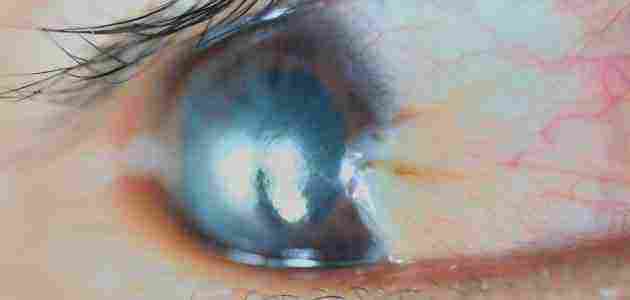 أعراض الإصابة بحبوب العين