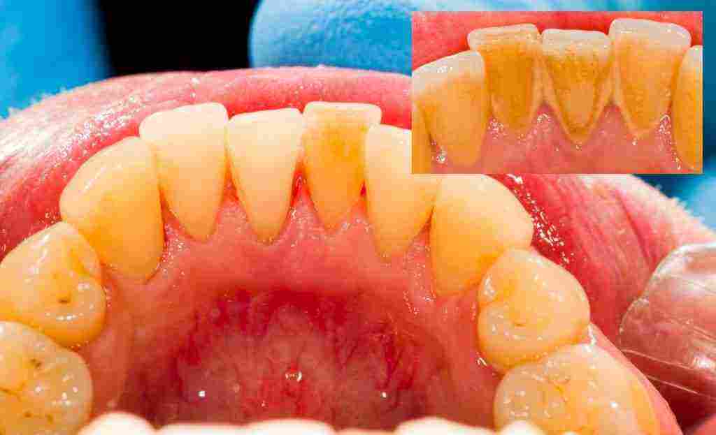 طريقة إزالة الجير من الأسنان آمنة 100%