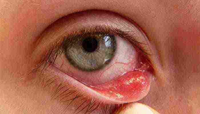 علاج الكيس الدهني في العين