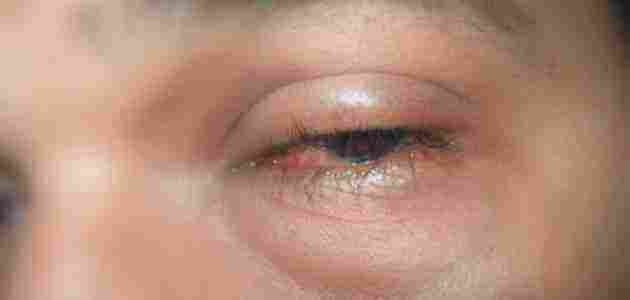 علاج انتفاخ جفن العين العلوي أو السفلي