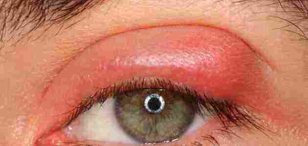 علاج انتفاخ جفن العين العلوي أو السفلي