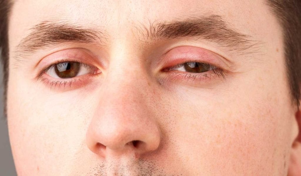 علاج انتفاخ العين بعد البكاء بعدة طرق - زيادة
