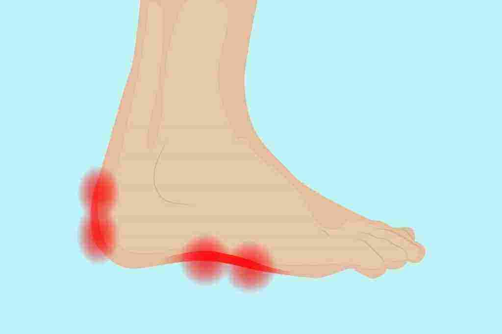 علاج التهاب أعصاب الساقين أسباب حالات التهاب الأعصاب في الساق زيادة