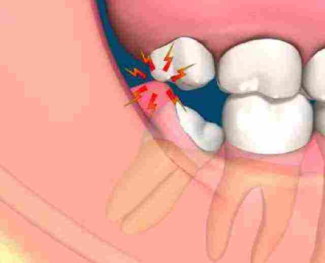 اعراض التهاب عصب الاسنان مع العلاج والاسباب