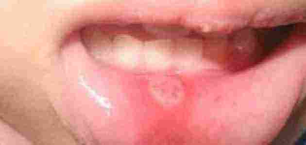 حبة داخل الفم على الخد غير مؤلمة هل تُشبب خطورة ؟