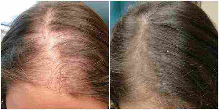 علاج فراغات الشعر في مقدمة الرأس