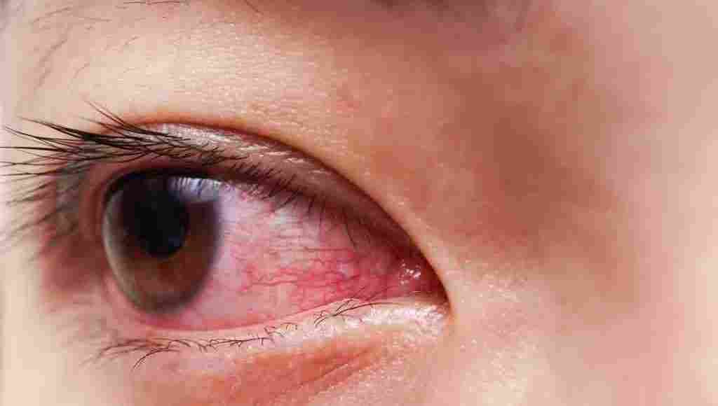 اعراض جفاف العين والصداع