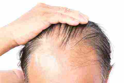 تكثيف الشعر عند الرجال