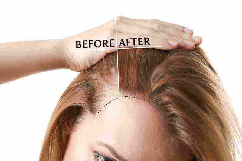 علاج تساقط الشعر  