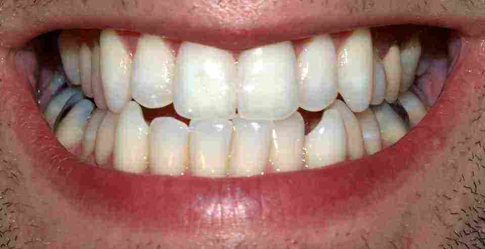كم عدد أسنان الإنسان العادي