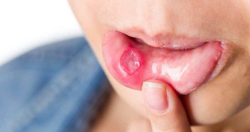 علاج الحبوب داخل الفم ومضاعفاتها واسبابها ونصائح هامة لتقليل ظهور حبوب الفم زيادة