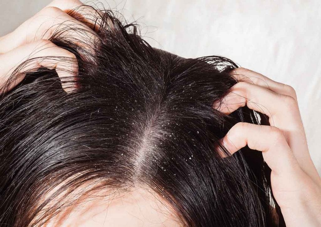 تحت ارتياح محامي  علاج القشرة في الشعر – زيادة