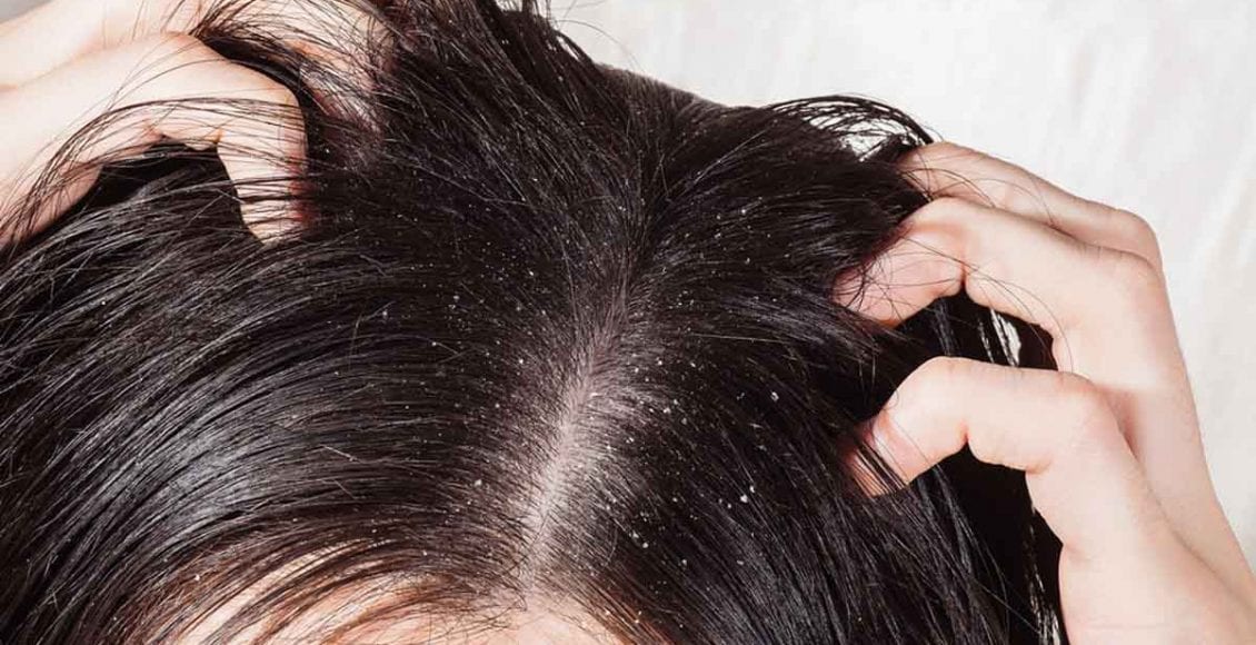 علاج القشرة في الشعر من اول مرة