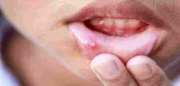 علاج تقرحات الفم بالطحينة