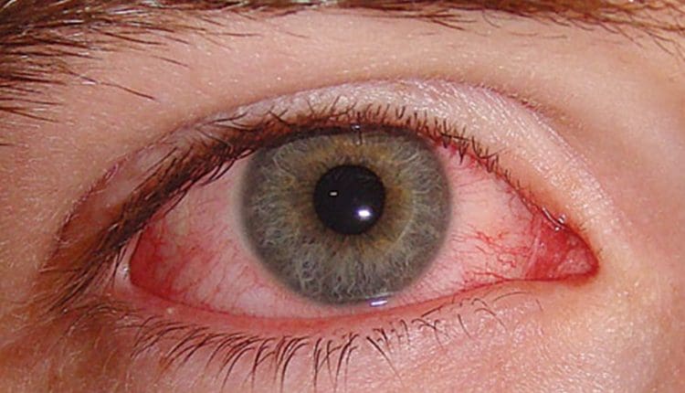 علاج ارتفاع ضغط العين بالاعشاب