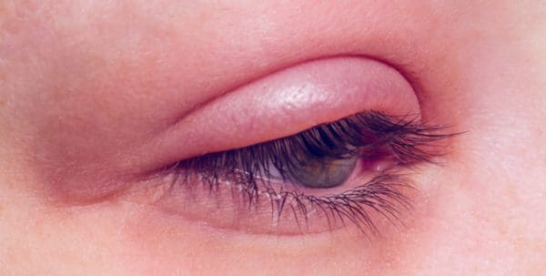علاج التهاب جفن العين في المنزل وأنواع التهابات العين ...