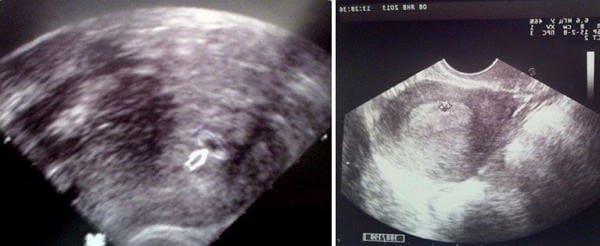 مراحل نمو الجنين داخل الرحم بالصور 1