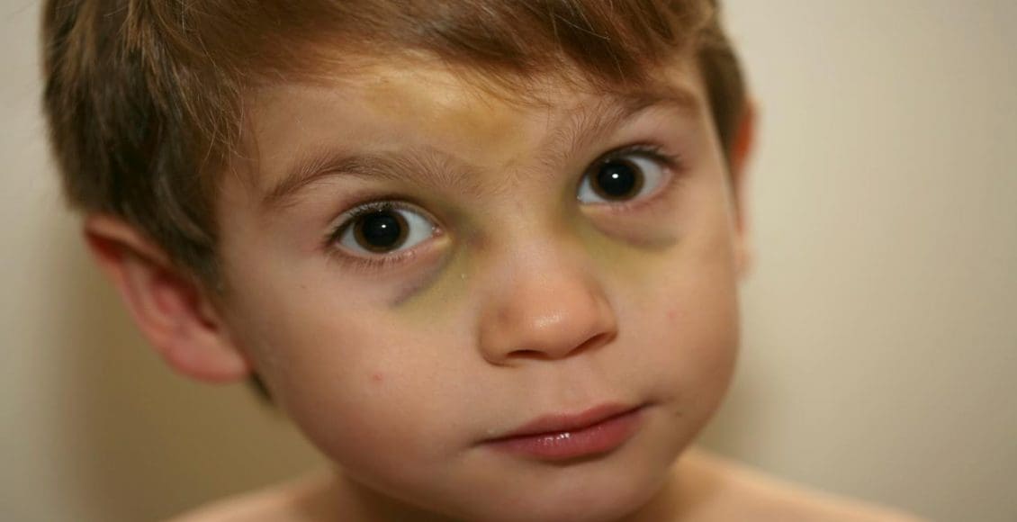 أسباب السواد تحت العين عند الأطفال