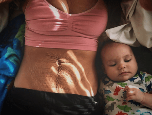 ترهلات البطن بعد الولادة